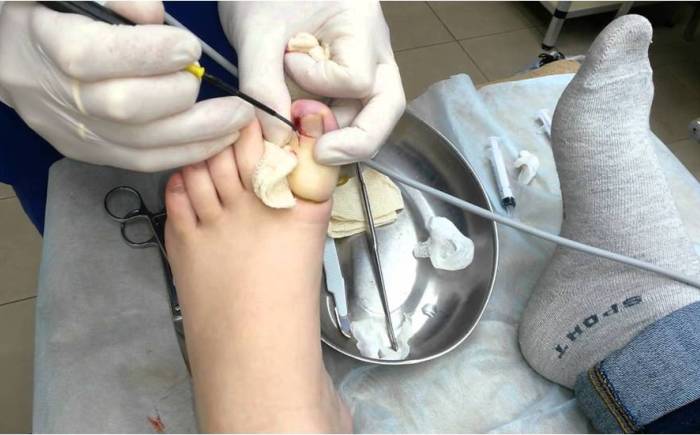 Как вылечить грибок ногтей на ногах 