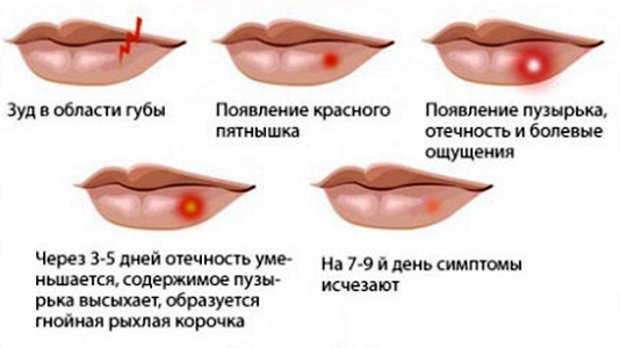 Как вылечить герпес на губах 